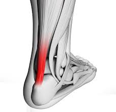 The anterior cruciate ligament prevents the femur from sliding backward on the tibia (or the tibia sliding forward on the femur). Achilles Tendon Pain Fairfield Podiatry