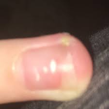 Gruner Punkt Neben Dem Fingernagel Nagel Grun Eiter