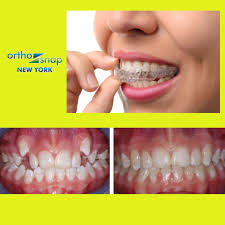 Is there any possible way to straighten teeth without braces? How To Get Straight Teeth Without Braces Arxiusarquitectura