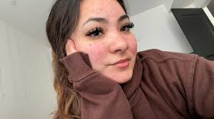 Recommendations for hormonal facial acne?