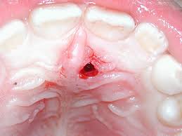 Check spelling or type a new query. Hyperdontia Mesiodens