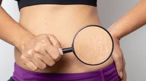 Stretch mark bukan penyakit yang berbahaya namun bila dibiarkan dapat mengganggu penampilan. Cara Menghilangkan Stretchmark Pasca Melahirkan