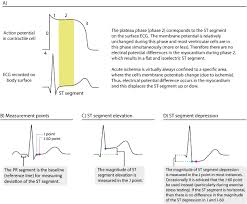 Ecg In Myocardial Ischemia Ischemic Changes In The St Segment T Wave Ecg Echo