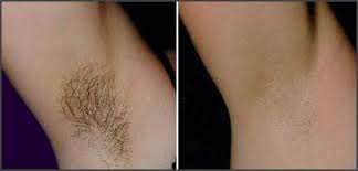 Laser hair removal works on just about any area of the body where smooth skin is desired… underarms, face, neck, back, legs, shoulders, bikini line, you name it. Laser Hair Removal Medical Day Spa Of Chapel Hill