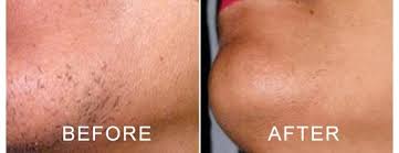 Laser hair removal is permanent when the hair follicle is destroyed. Permanent Laser Hair Removal Treatment In Ludhiana Laser Treatment For Full Body In Ludhiana Laser Hair Removal In Ludhiana Full Body Permanent Laser Hair Removal In Ludhiana Laser For Bikini Hair Removal