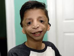 All boy with rare condition wants for Christmas is his two ears