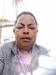 Paciente que aguarda cirurgia bucomaxilofacial com urgência apela ao  prefeito Rafael Piovezan por meio de ofício