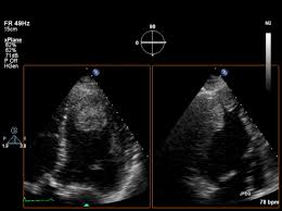 33 results for large windsock. Guidelines For The Use Of Echocardiography In The Evaluation Of A Cardiac Source Of Embolism Sciencedirect