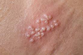 Image result for genital warts