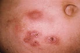 There are drugs that can help clear up this condition. Case Study Skin Infection In A Diabetic Patient Related To Contamination Of An Insulin Bottle Clinical Diabetes