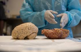 Cte stands for chronic traumatic encephalopathy. Brain Disease Is Found In Veterans Exposed To Bombs The New York Times