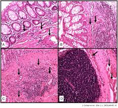 Diversion colitis (dc) involves nonspecific colonic inflammation following surgical diversion of the fecal stream away from the upstream colon. Efficacy Of Baccharis Dracunculifolia In The Treatment Of Diversion Colitis In Rats Journal Of Coloproctology