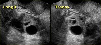 Ovarian cysts are commonly encountered in gynecological imaging, and vary widely in etiology, from physiologic, to complex benign, to neoplastic. The Radiology Assistant Ovarian Cystic Lesions