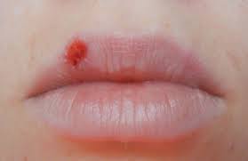 Virusurile herpes simplex infecteaza celulele neuronale, dar nu le ucid ; Cum Scapi De Herpes Intr O Singura Zi Era Atat De Simplu Si Habar N Am Avut Ele Ro