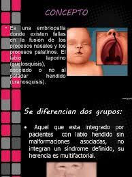 Labio leporino y paladar hendido. Labio Y Paladar Endido Artresia Esofagica Medicina Clinica Enfermedades Y Trastornos