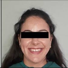 Determining the mandible's midsagittal plane: first, we performed a...