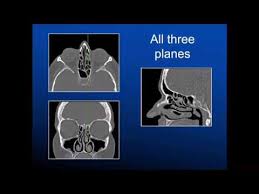 Image result for Sinus CT