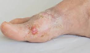 Image result for brown patches on the feet
