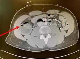 Image result for Neutropenic Colitis