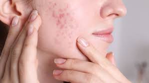 Image result for acne face