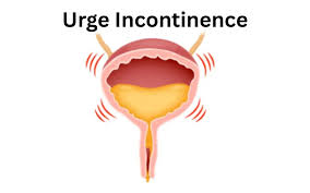 Image result for Stress Incontinence