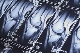 We did not find results for: How Long Does A Knee Mri Take Aica Orthopedics