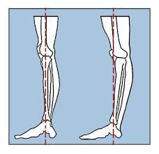 It is also referred to as genu recurvatum or having banana knees. Guidance For A Student With Hyperextended Knees Yoga Vista Academy