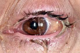 Image result for Conjunctivitis
