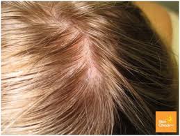 In fact, there&#x27;s a specific type of skin cancer that forms just on the palms, soles, and under the nail beds called acral lentiginous melanoma. Skin Cancer On Scalp Skin Check Waskin Check Wa