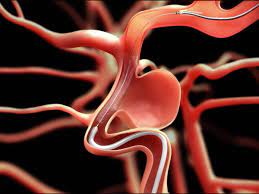 Stream tracks and playlists from aneurisma (oficial) on your desktop or mobile device. Aneurisma Cerebral Una Innovacion Medica Evitaria La Cirugia A La Que Tuvo Que Someterse Emilia Clarke De Game Of Thrones Infobae