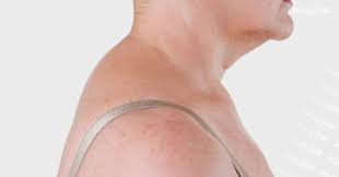 For neck pain or stiff neck. Fast Fix For Neck Hump