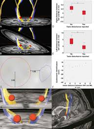 Image result for Thalamic Stimulation