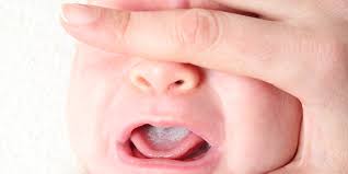 Image result for Oral thrush roof of mouth