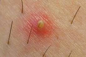 6 Naturalnych Srodkow Ktore Rozjasniaja Przebarwienia Na Skorze Ingrown Hair Ingrown Hair Remedies Ingrown Hair Removal