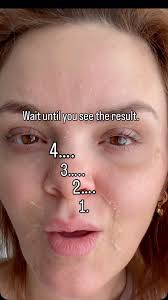 Good skin is a slow burn, not a microwave meal., ✨ The full result of a  chemical peel takes 7 days and it’s well worth it 👏 , Ready to shed the  summer dead? Add a peel