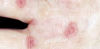 Image result for Erythema Multiforme Major