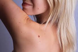 An example of how melanoma tumors are often asymmetrical (lopsided), unlike noncancerous moles. Melanoma Pictures Symptoms What Does Melanoma Look Like