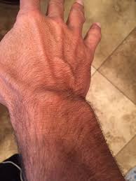 What is an ingrown hair? Essential Worker On Twitter Viclombardi Webmd Says Its Inoperable Cancer And You Ll Be Dead In A Week Or An Ingrown Hair