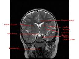 Normal Mri Brain