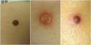 Ce se întâmplă dacă îţi rupi o aluniţă, cu adevărat? Ce E De FÄƒcut DacÄƒ Å£i Ai Rupt O AluniÅ£Äƒ Unica Md