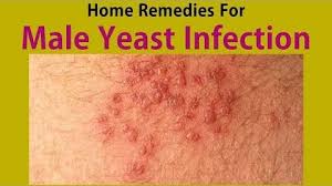 How to get rid of penile yeast infection. Top 5 Home Remedies For Male Yeast Infection Health Nigeria