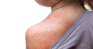 Image result for Measles