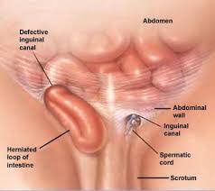 Image result for Inguinal hernia child