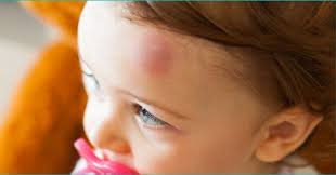 Image result for sores on the head in children