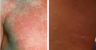 Image result for Scarlet Fever