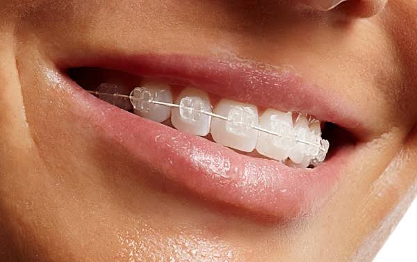 ceramic braces product image