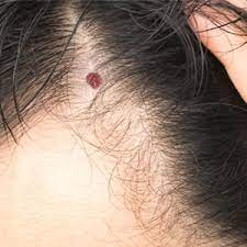 While there a many clinics who can safely remove these cherry red papules on the skin, it can be done at home quite easily. Cherry Angioma Removal Kent Red Spots Treatment Tunbridge Wells