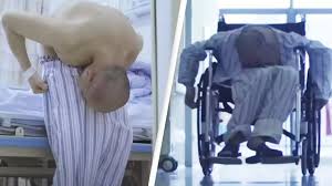 Spinal Kyphosis From Bent to Upright: After 28 Years, The Folded Man Receives Life-Changing Surgery