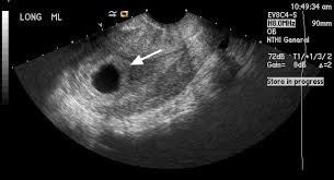 Fluid In The Pouch Of Douglas : Treatment & Prevention