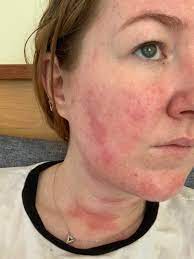 Soolantra is covered by some medicare and insurance plans. 5 Days Into Soolantra Please Tell Me This Gets Better Rosacea